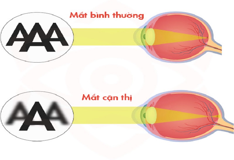 Cận thị