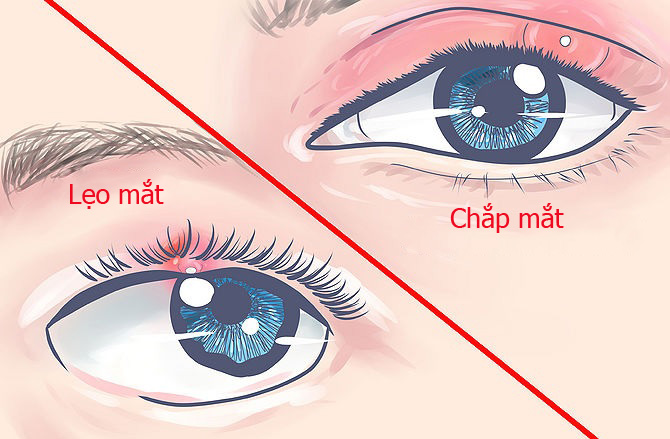 Chắp và lẹo mắt