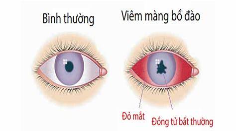 Viêm màng bồ đào