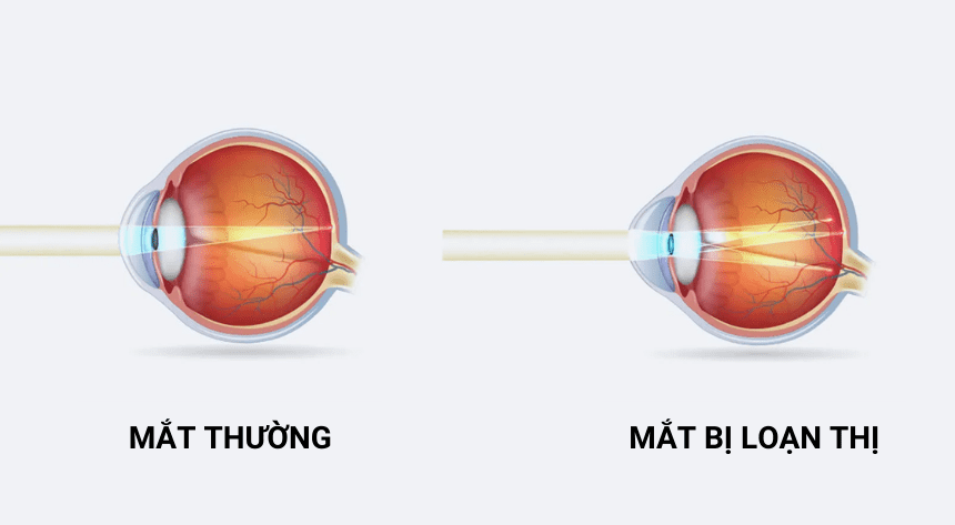 Loạn thị