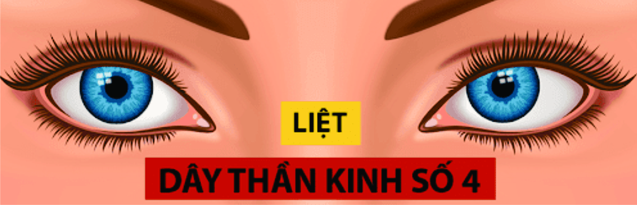 Liệt dây thần kinh số IV