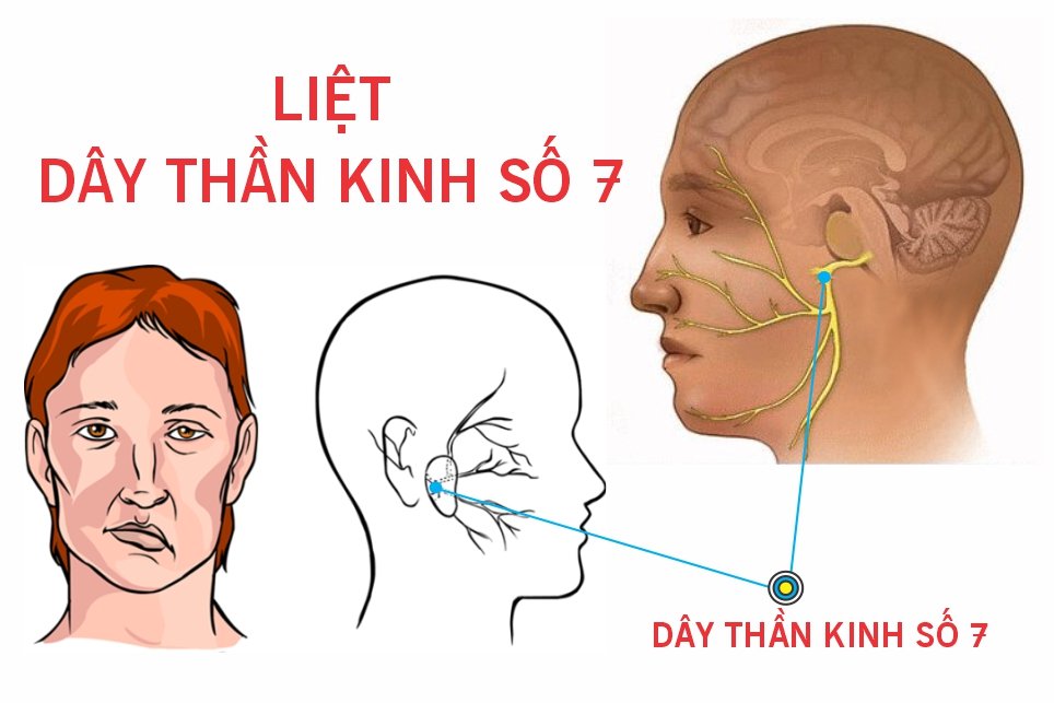 Liệt dây thần kinh số VII