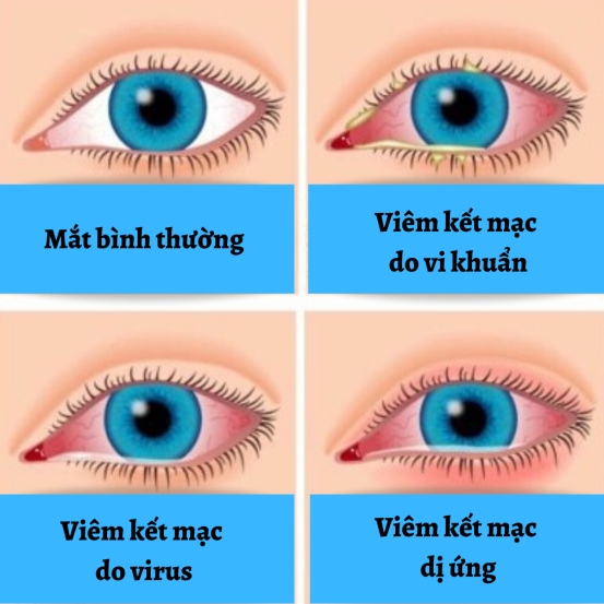 Viêm kết mạc