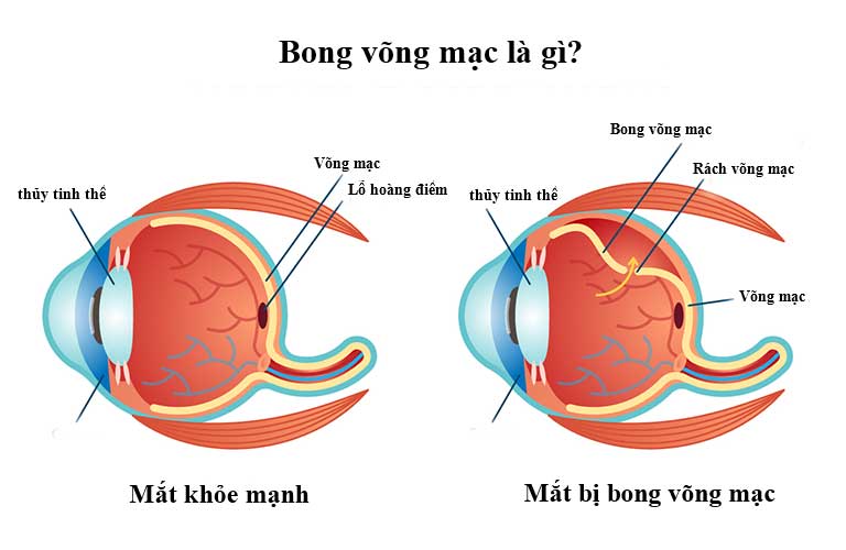 Bệnh bong võng mạc 