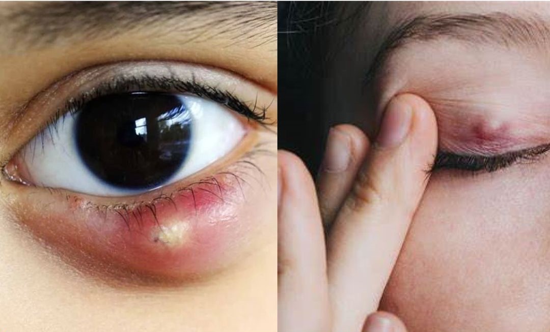 Chắp và lẹo mắt