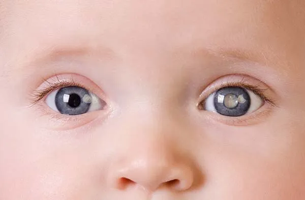 Điều trị đục thủy tinh thể bẩm sinh ở trẻ em
