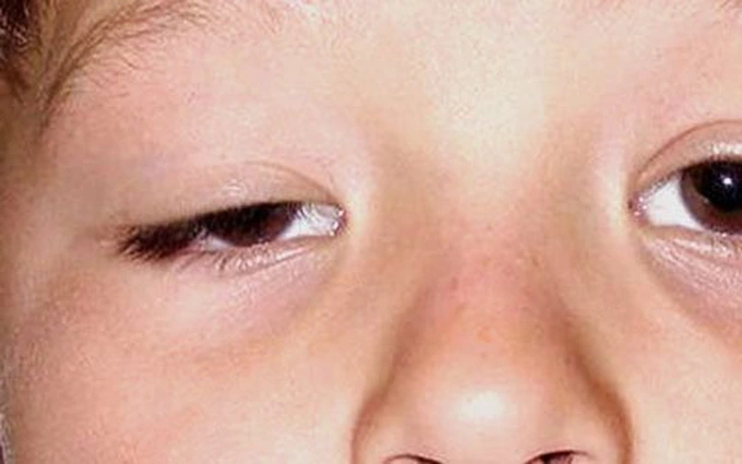 Hậu quả khi không điều trị kịp thời