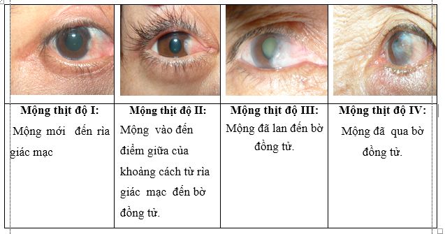 Mộng thịt