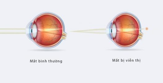 viễn thị