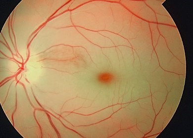 Tắc động mạch võng mạc