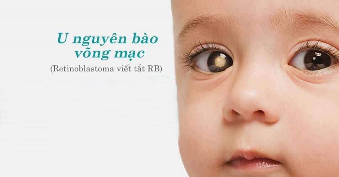 U nguyên bào võng mạc