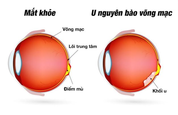 U nguyên bào võng mạc