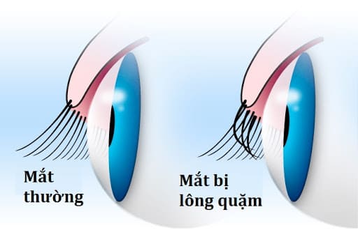Quặm mi bẩm sinh