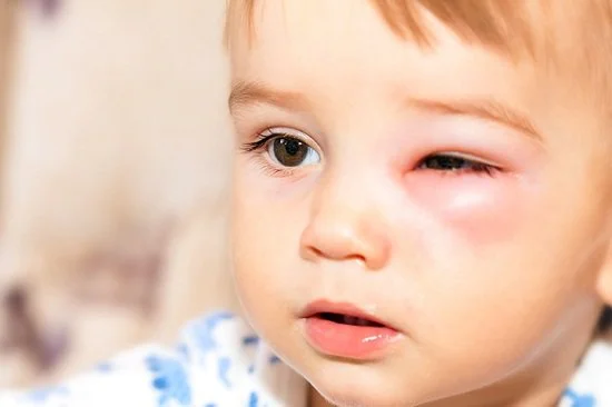 Viêm kết mạc trẻ sơ sinh