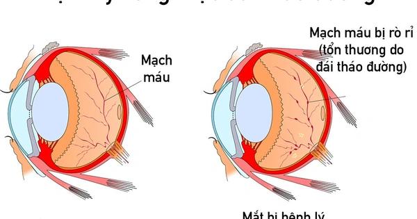 Võng mạc đái tháo đường